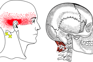 施術例｜肩甲骨の動きにくさに対する見立てと施術の流れの一例